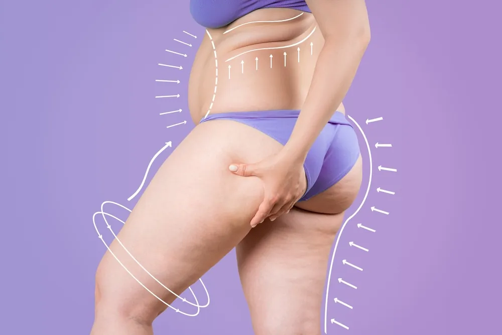 Factors That Affect the Cost of Brazilian Butt Lift Surgery in D.C.