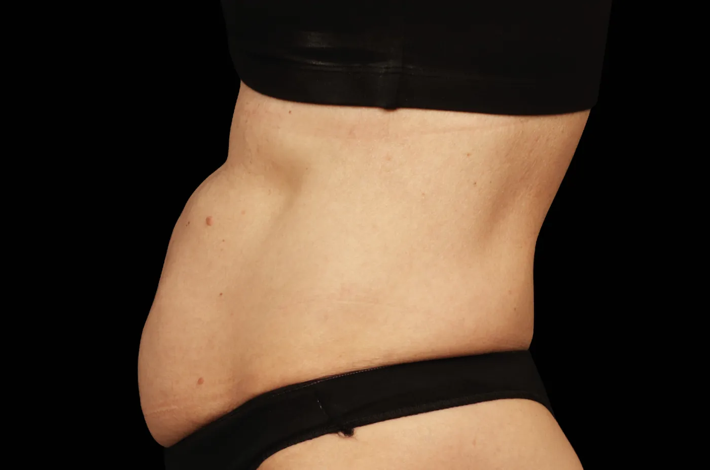 Before image showcasing a subject's body prior to undergoing EmSculpt Neo treatment, highlighting areas for potential improvement and sculpting.