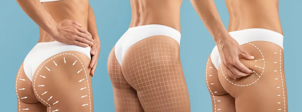 Why You Should Schedule a Free BBL Fat Transfer Consultation Near Capitol Hill DC