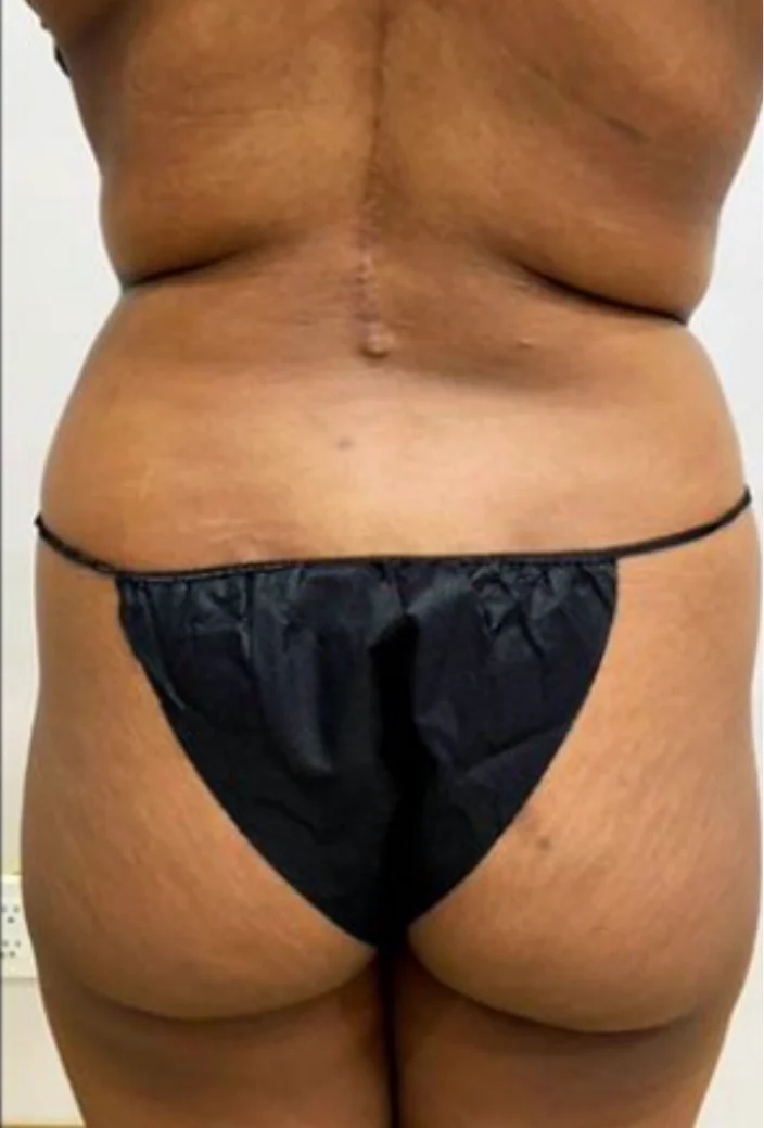 Case 1, before surgery, back view