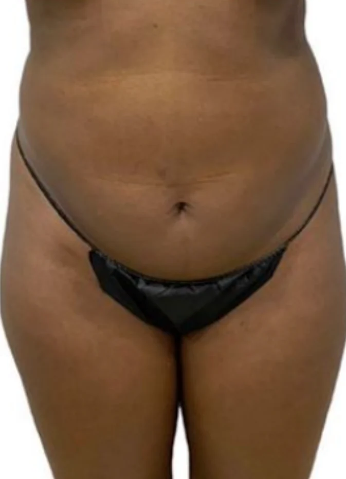 Case 3, before surgery, front view