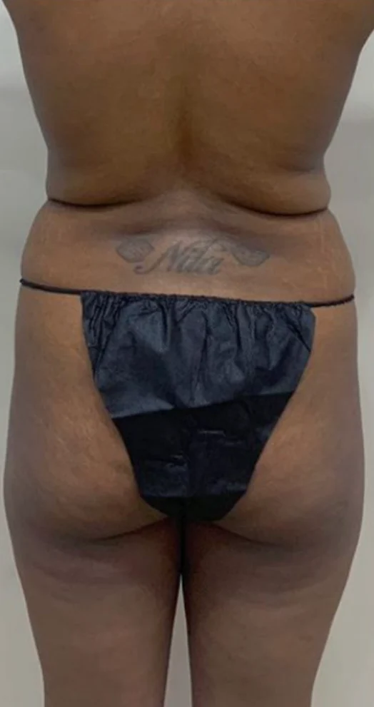 Case 4, before surgery, back view