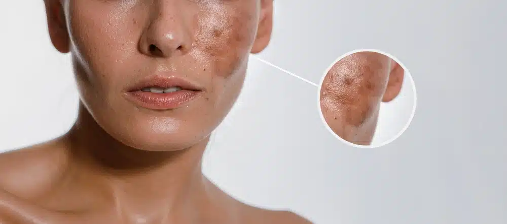 Wondering How to Best Remove Melasma for Good?