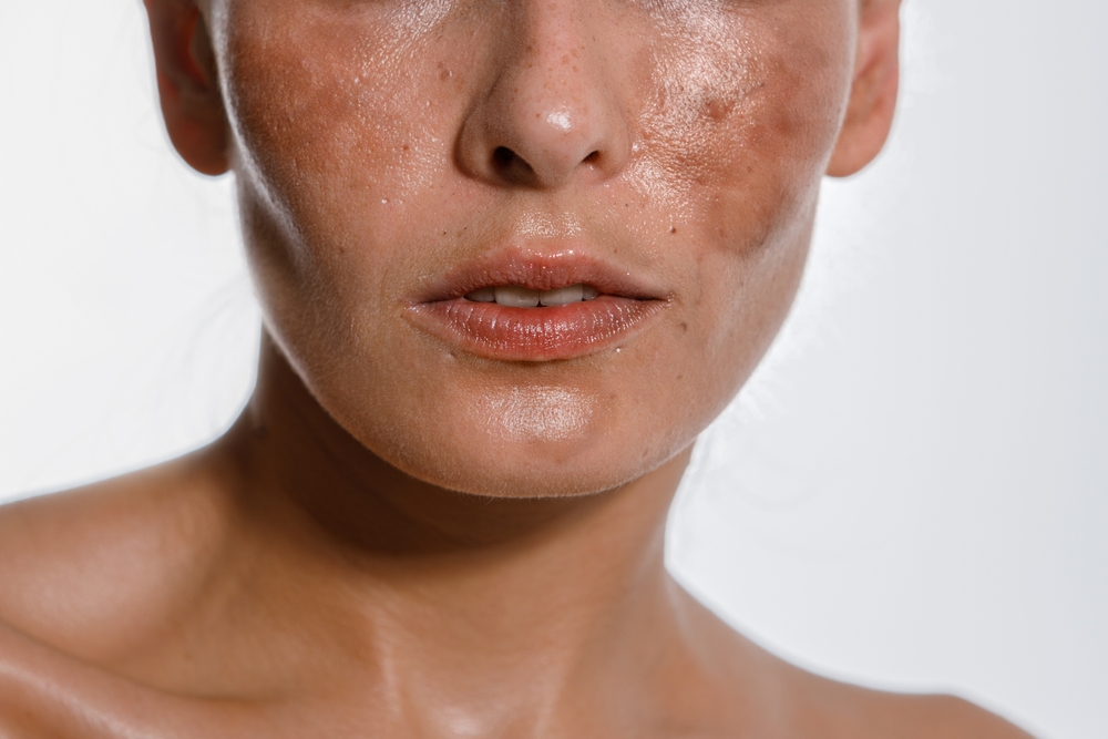 Best Melasma Treatment in DC