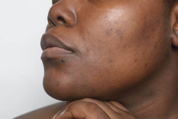 woman with dark spots on dark skin in DC