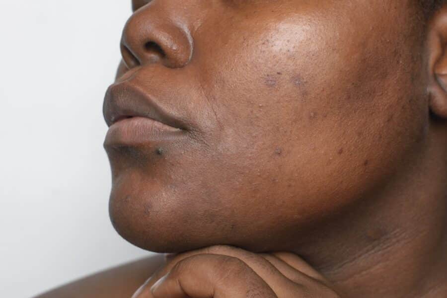 woman with dark spots on dark skin in DC
