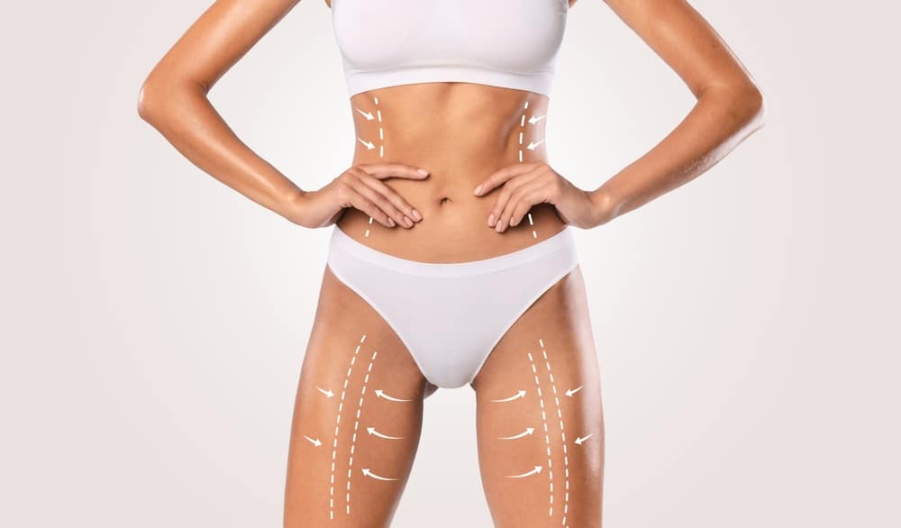 Liposuction Prices by Treatment Area Explained