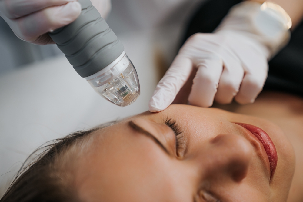RF microneedling in Foggy Bottom