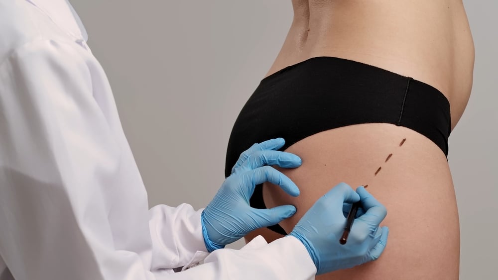 Brazilian Butt Lift Pricing in Washington DC